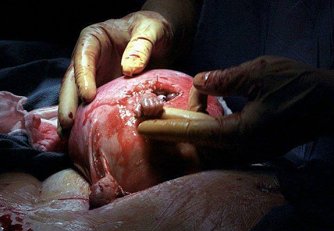 Бебе, Самюел, спина бифида, операция в утробата