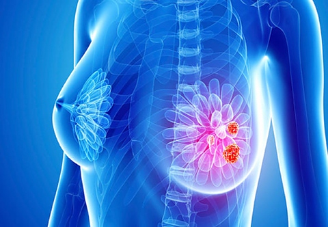необичайни симптома на рака на гърдата