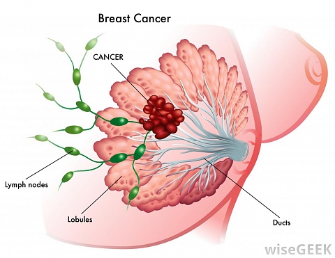 Рак на гърдата без химиотерапия