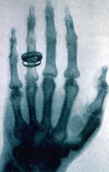 Рьонтген създава рентгеновия апарат и получава Нобелова награда