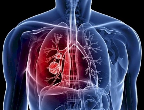 рака на белите дробове симптоми причини