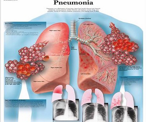 Вирусна или бактериална пневмония
