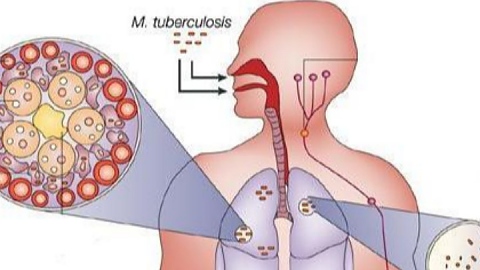 Безплатни прегледи за туберкулоза