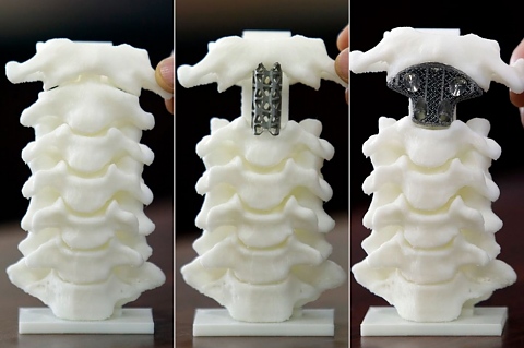 импланти с 3D принтер