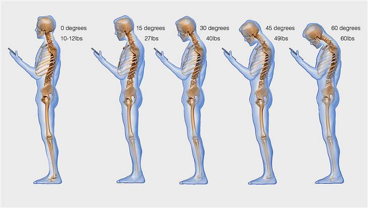 смартфоните увреждат гръбначния стълб